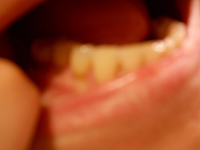 back teeth and gums of nancy gurish mouth, image taken by Nancy K Gurish, Editor Your Health And Tech Friend Magazine, A Julialanan Production LLC,