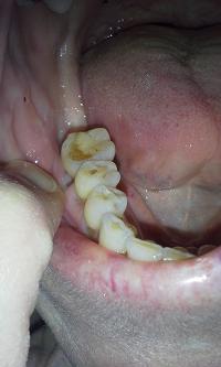 large cavity in my bottom tooth nancy gurish