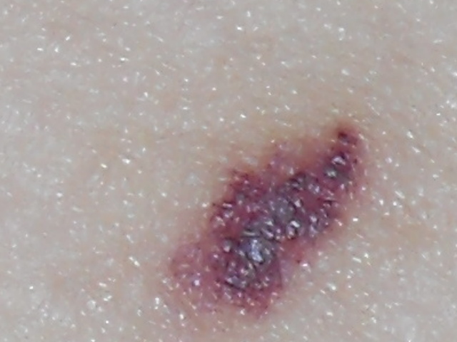 melanoma tumor growth