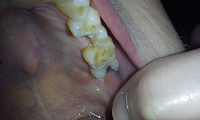 cracked tooth healing upper tooth.  Photo taken by Nancy K Gurish, Editor Your Health And Tech Friend Magazine, A Julialanan Production, LLC.